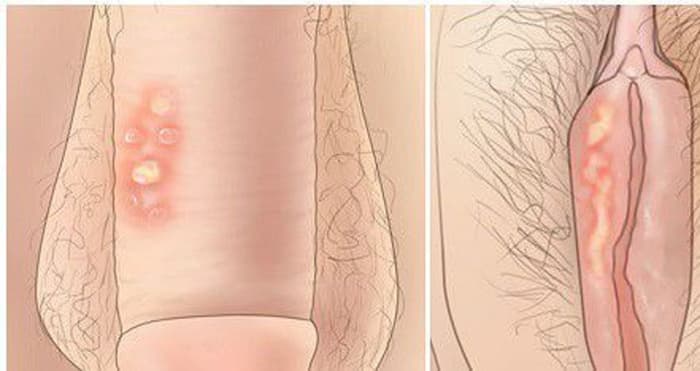 Obat Sipilis Tanpa Resep Dokter