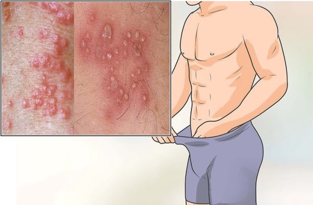 Obat Sipilis Banyumas Kabupaten Banyumas Jawa Tengah